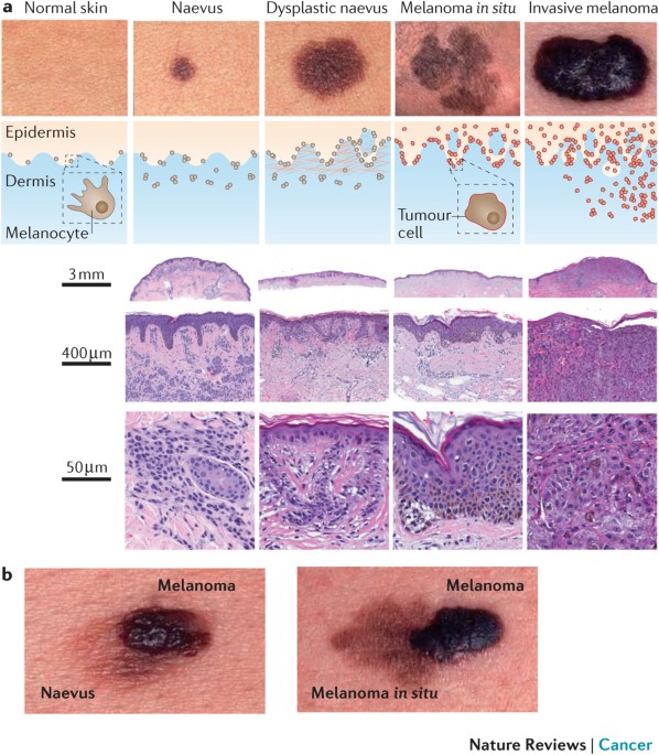 From melanocytes to melanomas | Nature Reviews Cancer