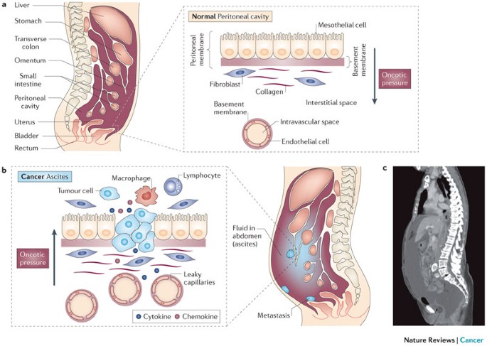paraziti u usima kod ljudi cancer de prostata biologia