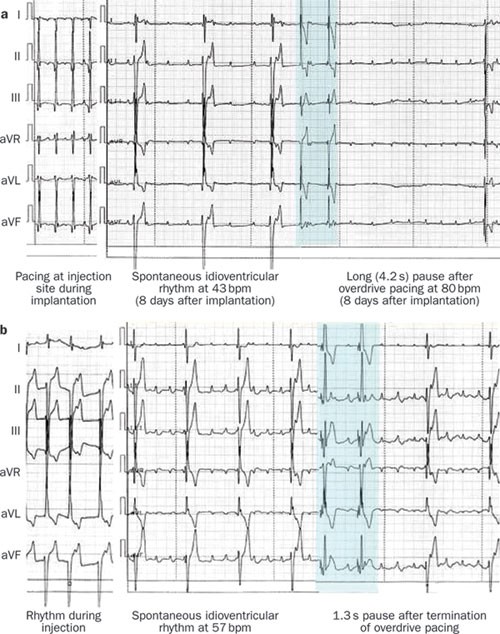 DVNE PaceMaker