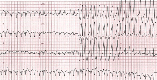 The Diagnosis And Management Of Ventricular Arrhythmias Nature Reviews Cardiology