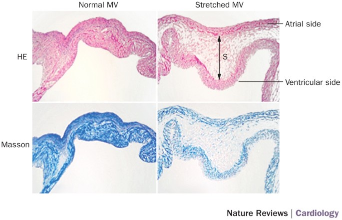 Mitral valve disease—morphology and mechanisms | Nature Reviews Cardiology