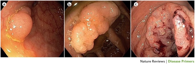 rectal cancer and colon cancer