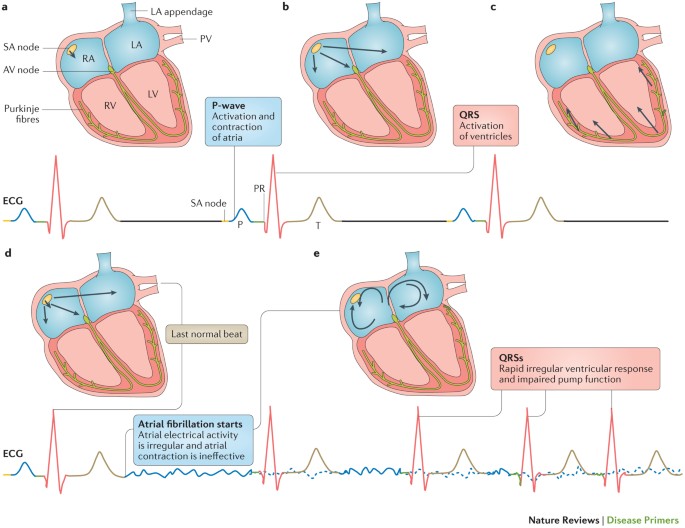 Atrial Fibrillation Nature Reviews Disease Primers Atrial Fibrillation Nature Reviews Disease Primers