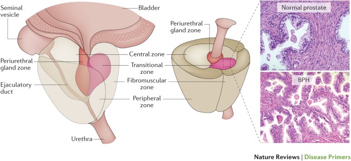 bph vs prostate cancer zone