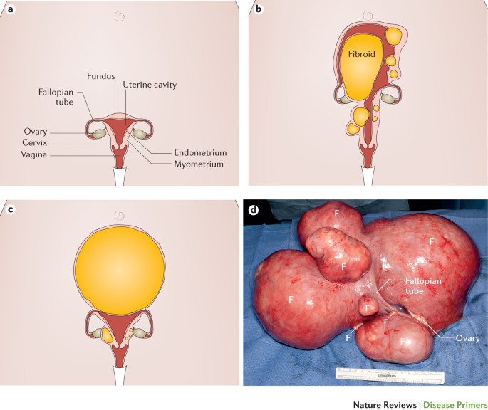 Uterine Fibroid Size Chart