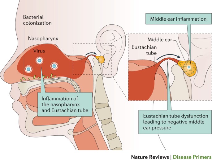 Diagnosis, Natural History, and Late Effects of Otitis Media with