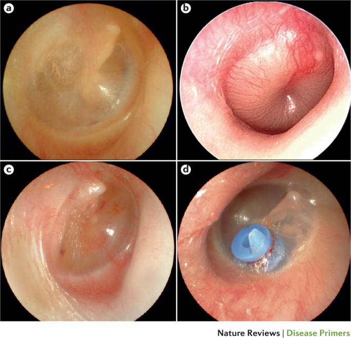 normal tympanic membrane vs bulging