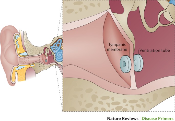 Antibiotics for otitis media with effusion in children - Venekamp