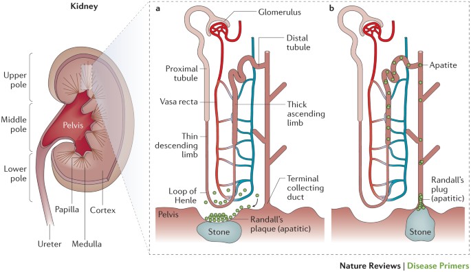 Kidney Stones Nature Reviews Disease Primers