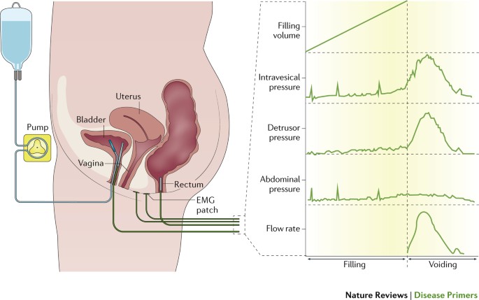Urinary incontinence in women  Nature Reviews Disease Primers