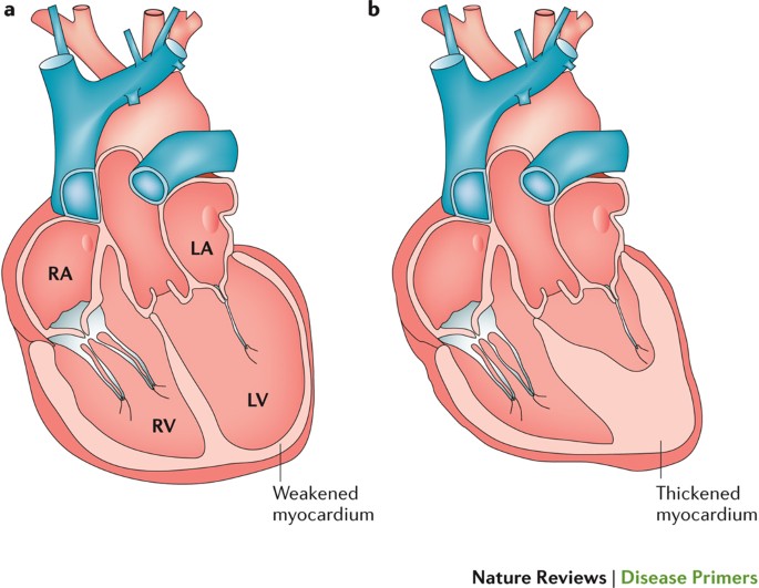Heart Failure With Reduced Ejection Fraction | Nature Reviews Disease  Primers