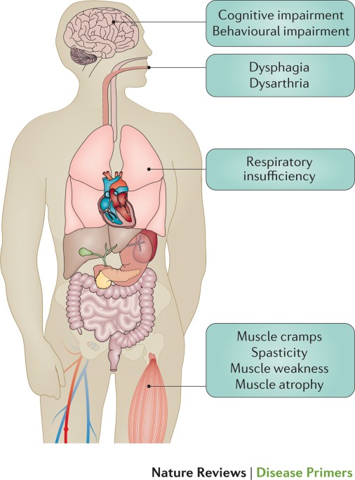 Amyotrophic lateral sclerosis | Nature Reviews Disease