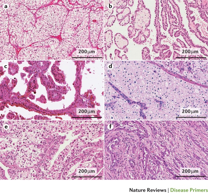 Renal cell carcinoma | Nature Reviews Disease Primers