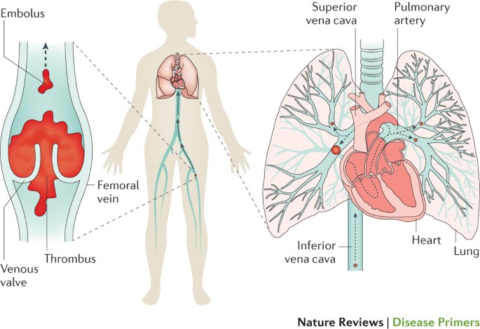 Pulmonary embolism | Nature Reviews Disease Primers
