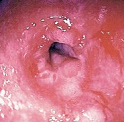 Ppis reduce benign anastomotic strictures after esophagectomy