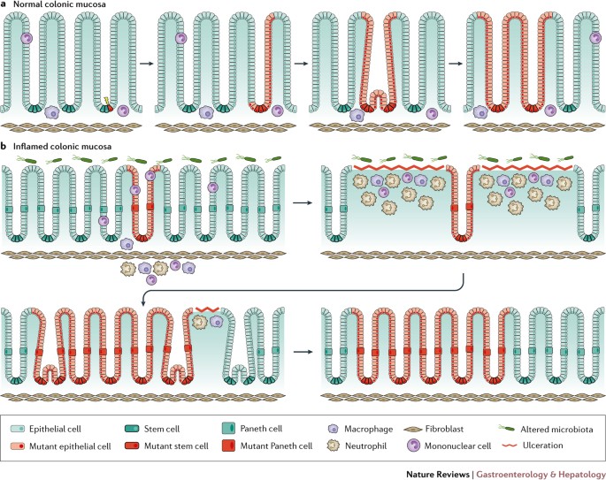 Clonal evolution of colorectal cancer in IBD | Nature Reviews  Gastroenterology & Hepatology