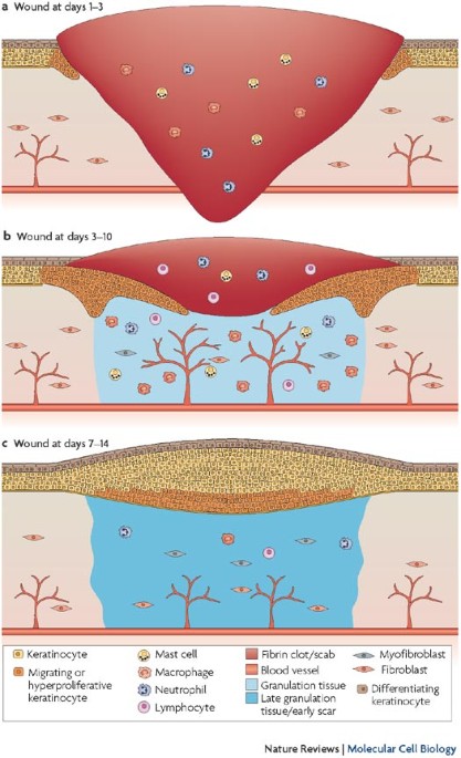 Cancer As An Overhealing Wound An Old Hypothesis Revisited Nature Reviews Molecular Cell Biology