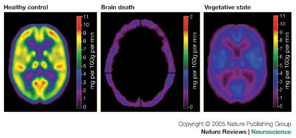 What is the Difference Between a Coma and Brain Death?