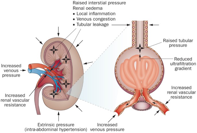 Fluid management for the prevention and attenuation of acute kidney injury  | Nature Reviews Nephrology