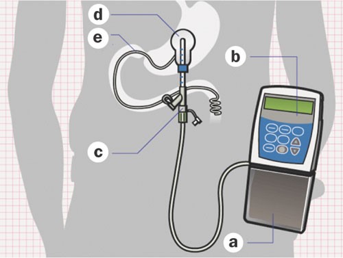 Intrajejunal duodopa improves nonmotor symptoms