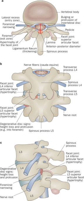 Lumbar spinal stenosis: syndrome, diagnostics and treatment | Nature Reviews Neurology