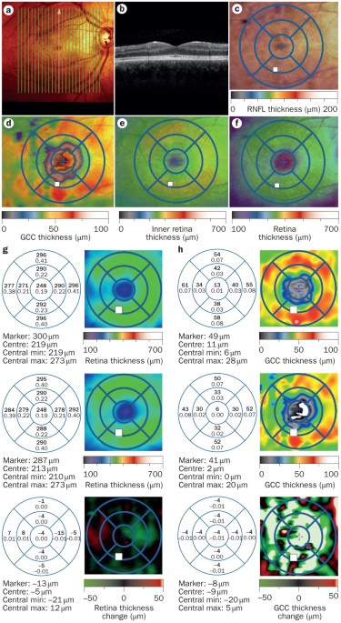 Visual Field Changes in Cone-Rod Degenerations