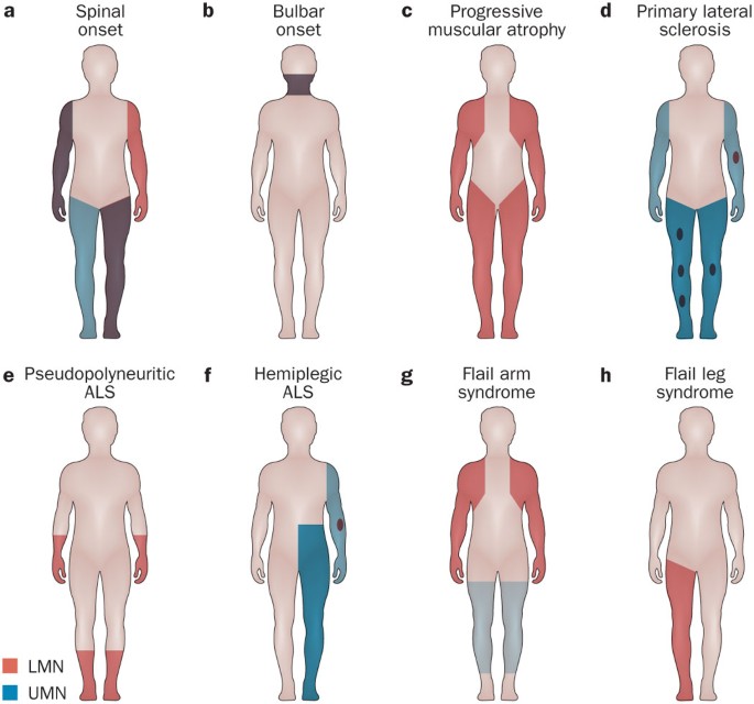 The phenotypic variability of amyotrophic lateral sclerosis | Nature  Reviews Neurology