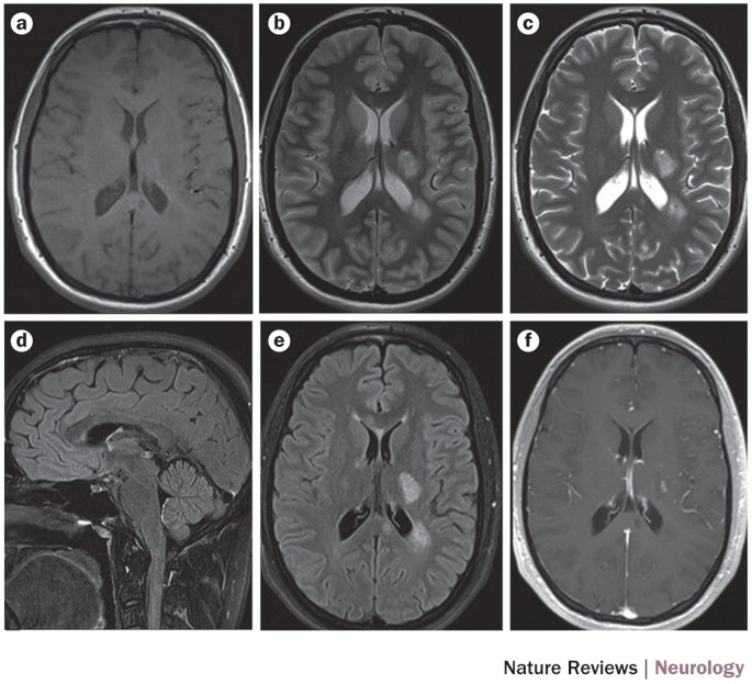 MAGNIMS consensus guidelines on the use of MRI in multiple sclerosis—clinical  implementation in the diagnostic process | Nature Reviews Neurology