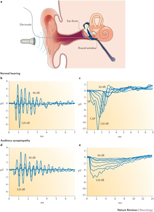 Auditory neuropathy — neural and synaptic mechanisms