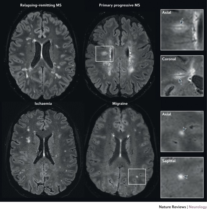 Get Multiple Sclerosis Mri Head Scan Background