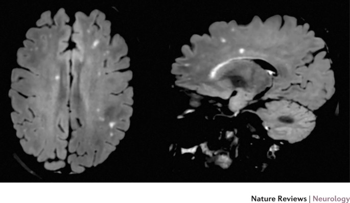 The Tension Between Early Diagnosis And Misdiagnosis Of Multiple Sclerosis Nature Reviews Neurology The Tension Between Early Diagnosis And Misdiagnosis Of Multiple Sclerosis Nature Reviews Neurology