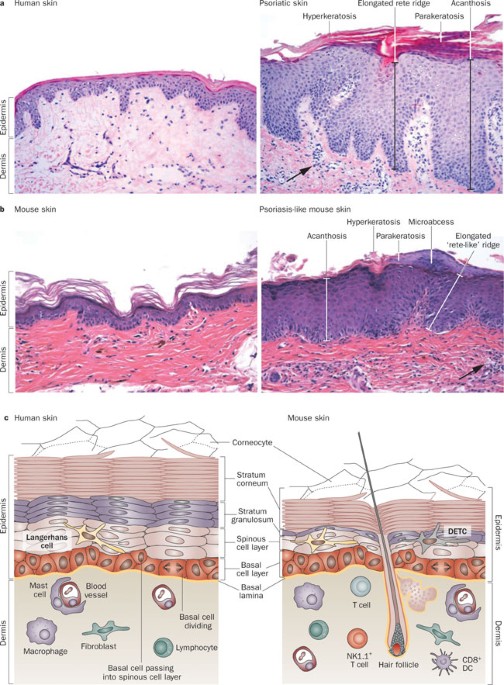 inverse psoriasis histopathology)