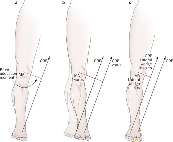 lateral heel wedge for medial knee pain