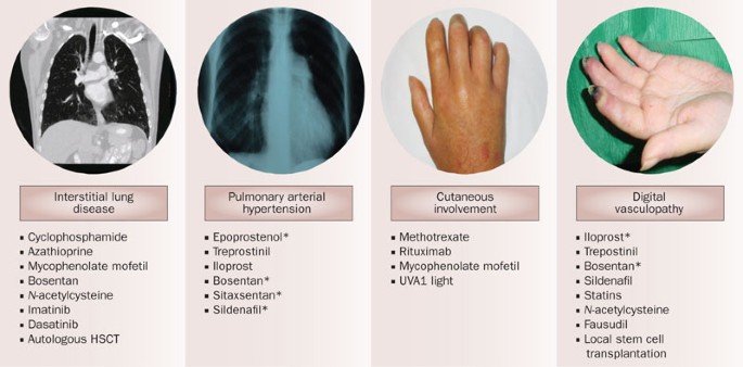 Targeted therapy for systemic sclerosis: how close are we?