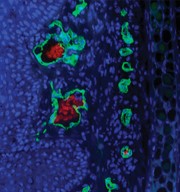Anti-vegf antibody therapy for psoriasis?