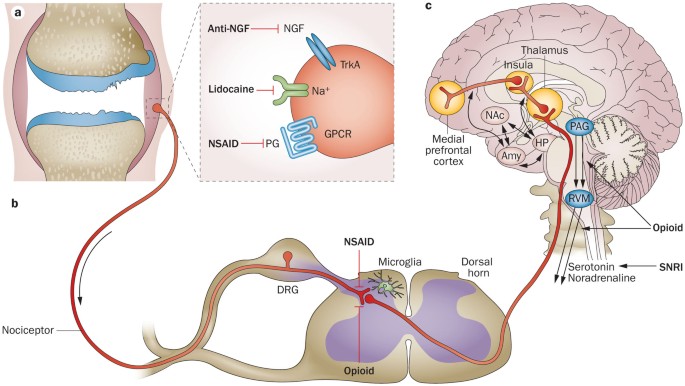 Towards a mechanism-based approach to pain management in osteoarthritis