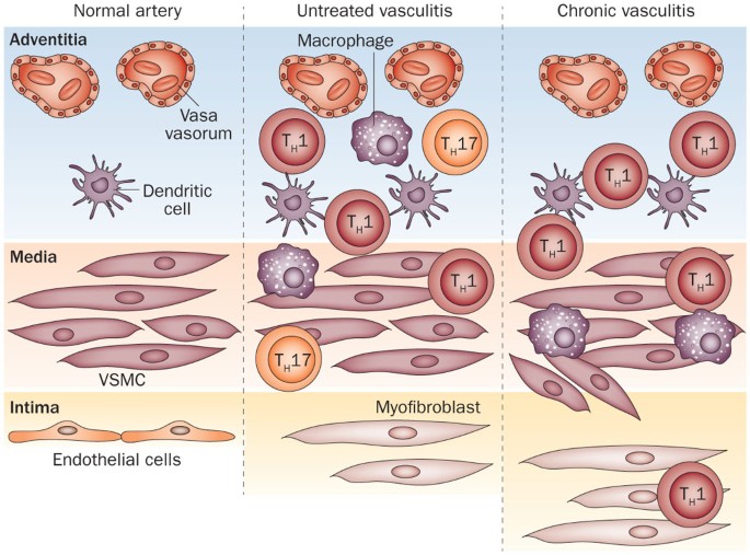 Immune mechanisms in medium and large-vessel vasculitis