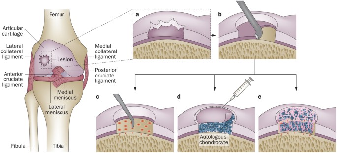 Repair and tissue engineering techniques for articular cartilage 