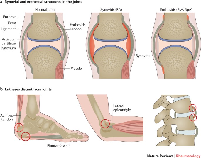 Enthesitis: from pathophysiology to treatment