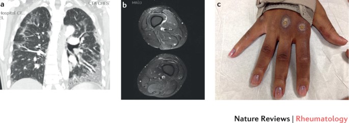 Prognostic factors in 'pneumo-myositis'