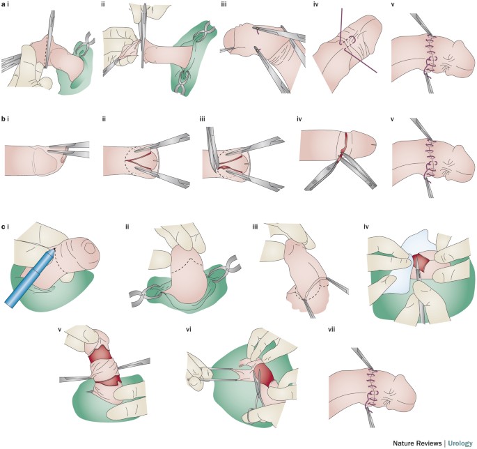 Voluntary medical male circumcision in resource-constrained settings |  Nature Reviews Urology