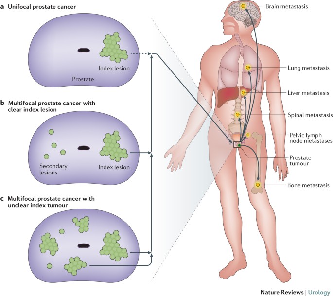 An Update On Focal Therapy For Prostate Cancer Nature Reviews Urology