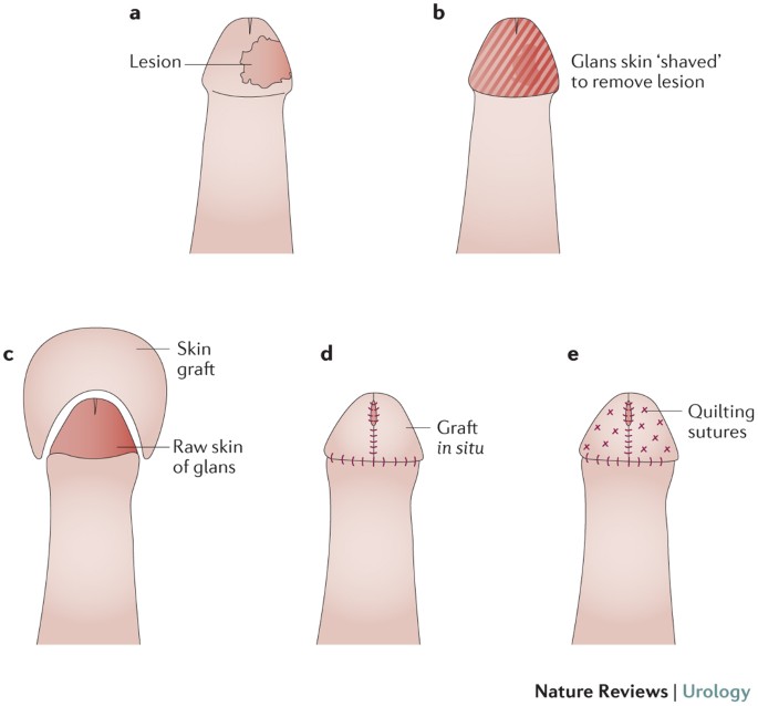 Foreskin Preservation in Penile Surgery