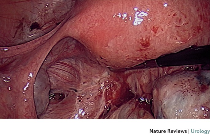 Catamenial rectal bleeding due to invasive endometriosis: a case