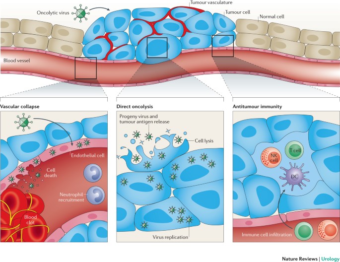 immunotherapy for prostate cancer australia)