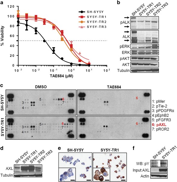 Alk inhibitor resistance in alkf1174l-driven neuroblastoma is associated with axl activation and induction of emt
