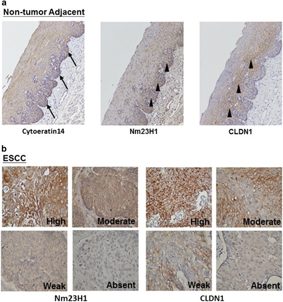 Nm23h1 Mediates Tumor Invasion In Esophageal Squamous Cell Nm23h1 Mediates Tumor Invasion In