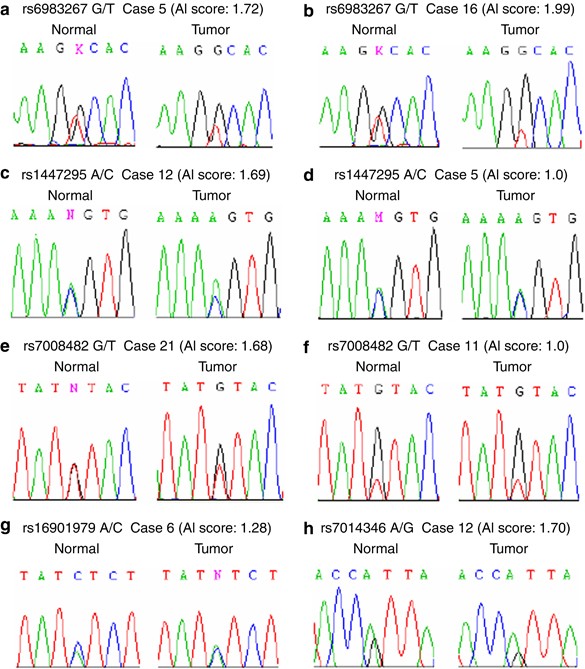 8q24 Allelic Imbalance And Myc Gene Copy Number In Primary Prostate Cancer Prostate Cancer And Prostatic Diseases