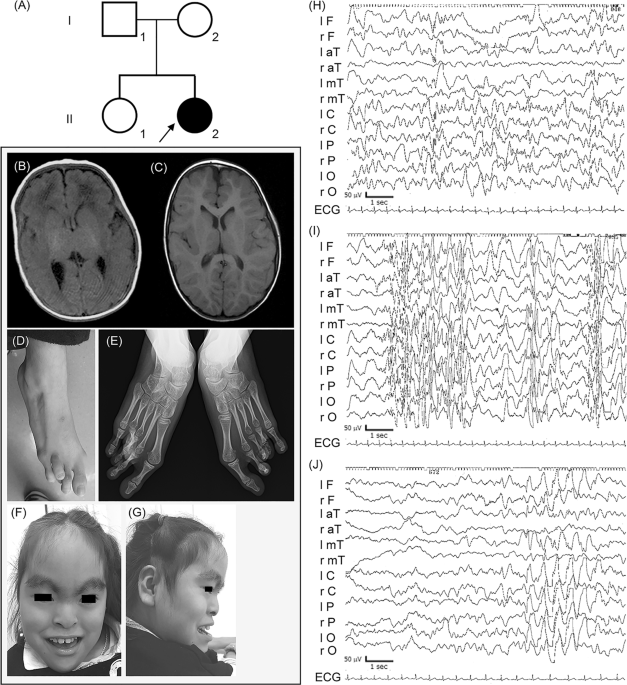Entire fgf12 duplication by complex chromosomal rearrangements associated with west syndrome