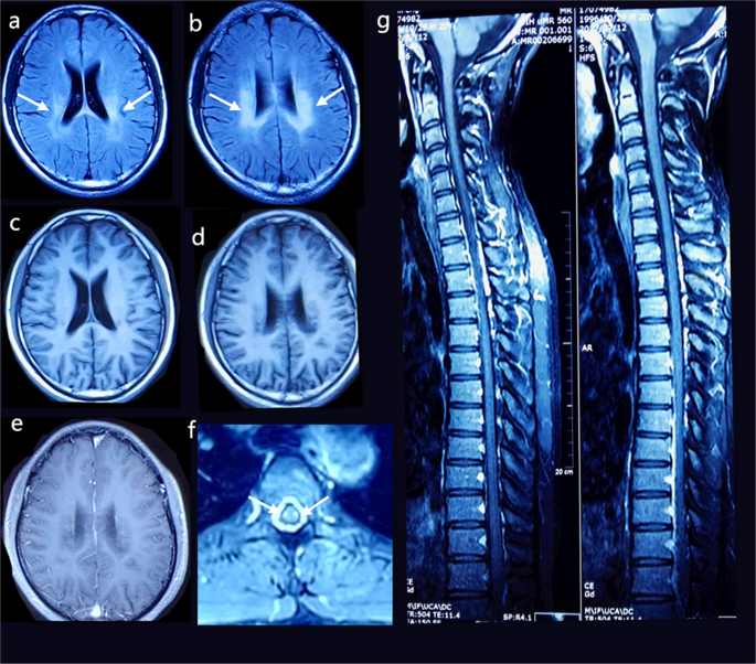 A novel compound heterozygous mutation in AARS2 gene (c.965 G > A, p.R322H;  c.334 G > C, p.G112R) identified in a Chinese patient with leukodystrophy  involved in brain and spinal cord